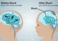 Brain Shunt surgery show promise in treatment of iNPH patients